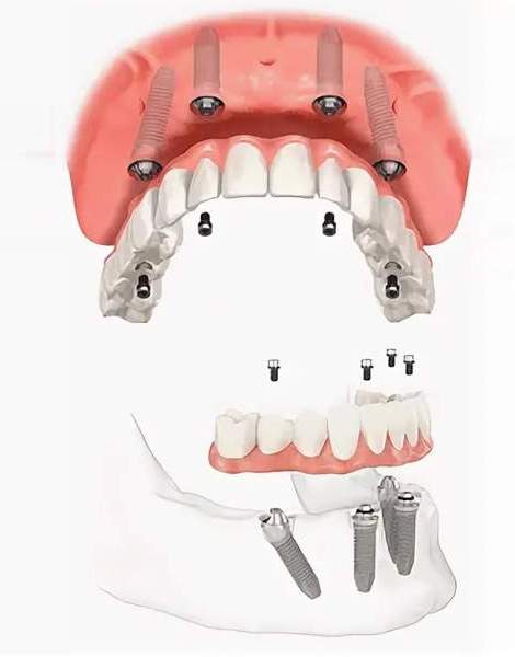 Всё про имплантацию зубов All-on-4 или всё на 4-х