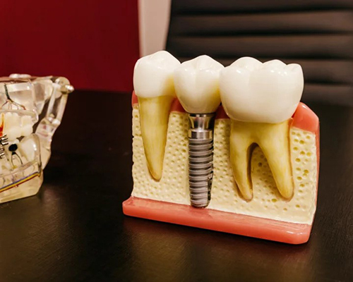 Восстановление зубов за одну процедуру по методике All-on-4: рассказывает хирург-имплантолог «Дентатэк» Геннадий Пермяков