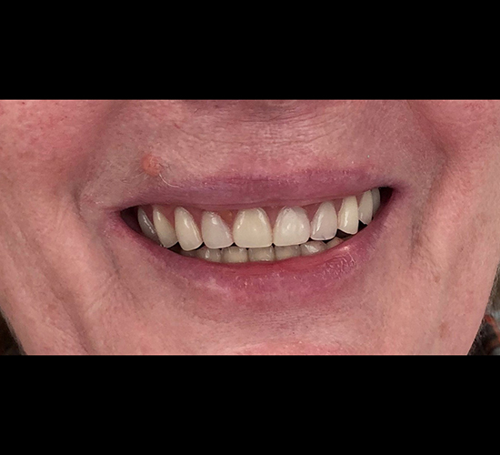 Имплантация зубов Пациентке (58 лет) был установлен протез по технологии "All-on-4"