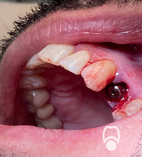 Имплантация зубов Пациент Сурен (35 лет) обратился с разрушенным кариесом зубом.