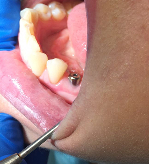 Имплантация зубов - пример работы