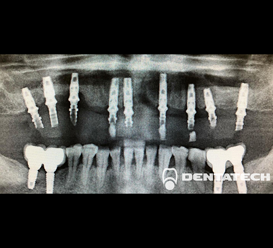 Имплантация зубов Протезиирование.Пациент обратился с отсутсвием почти всех зубов на верхней челюсти.