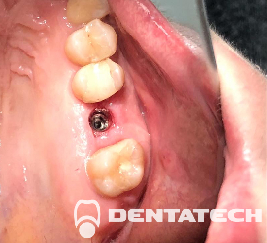 Имплантация зубов У пациента отсутствовал зуб.