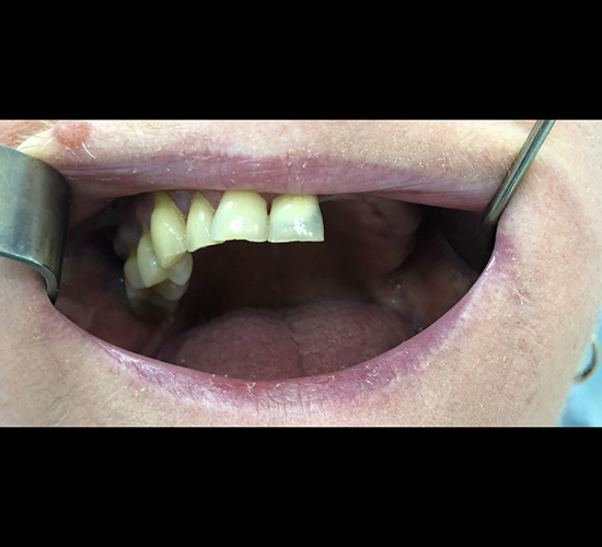 Имплантация зубов Пациентке (58 лет) был установлен протез по технологии "All-on-4"