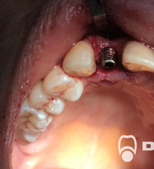 Имплантация зубов Проведена операция по установке имплантата Альфа Био