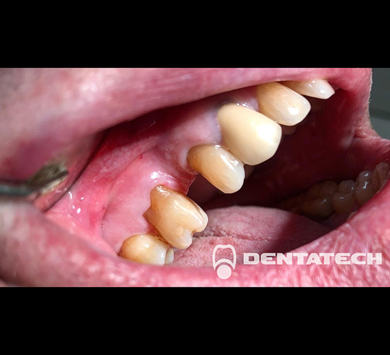 Имплантация зубов Пациенту Алексею (56 лет)несколько лет назад был удален зуб.