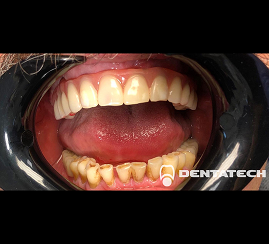 Имплантация зубов Протезиирование.Пациент обратился с отсутсвием почти всех зубов на верхней челюсти.