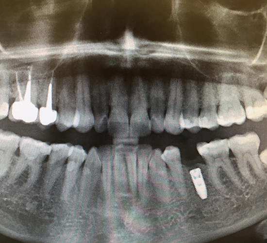 Имплантация зубов Neodent Straumann - пример работы