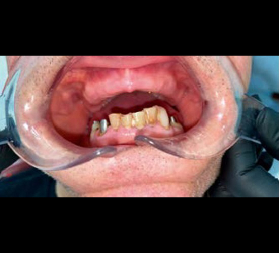 Имплантация зубов Пациенту (64 года) был установлен протез по технологии "All-on-4" на имплантах NeoDent.