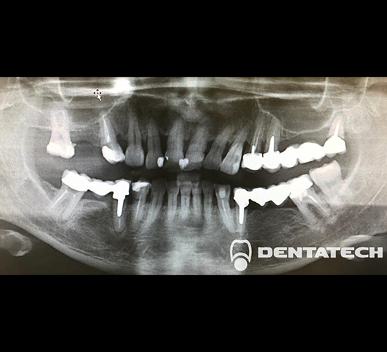 Имплантация зубов Пациентка обратилась с проблемой частичной адентии