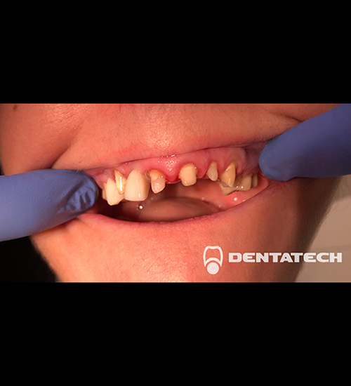 Имплантация зубов Пациентка обратилась с болью на 13 зуб