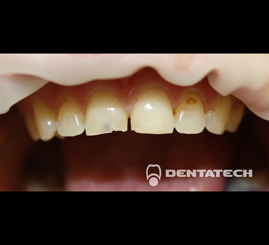 Восстановление и реставрация зубов