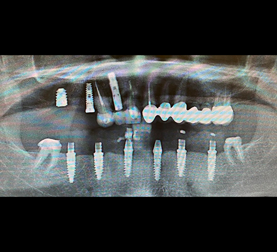 Имплантация зубов Пациент обратился с диагнозом частичная вторичная адентия и пародонтит.